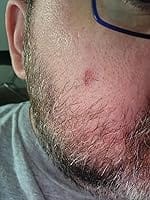 Customer photo review of 272 CT Variety Pack Pimple Patches Hydrocolloid Patch Spot Treatment