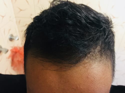 Customer photo review of Minoxidil 5% FOAM, 3x60ml pack