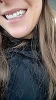 Customer photo review of 240 CT Pink & Clear Superstar Pimple Patches Hydrocolloid Patch Spot Treatment with Salicylic Acid & Tea Tree Oil