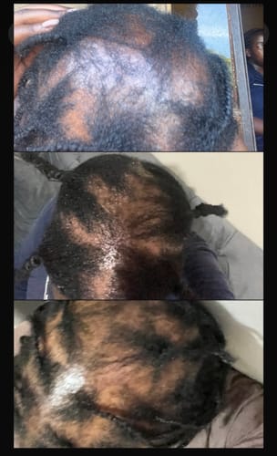 Customer photo review of Minoxidil High Strength (5%) SOLUTION, 3x60ml pack