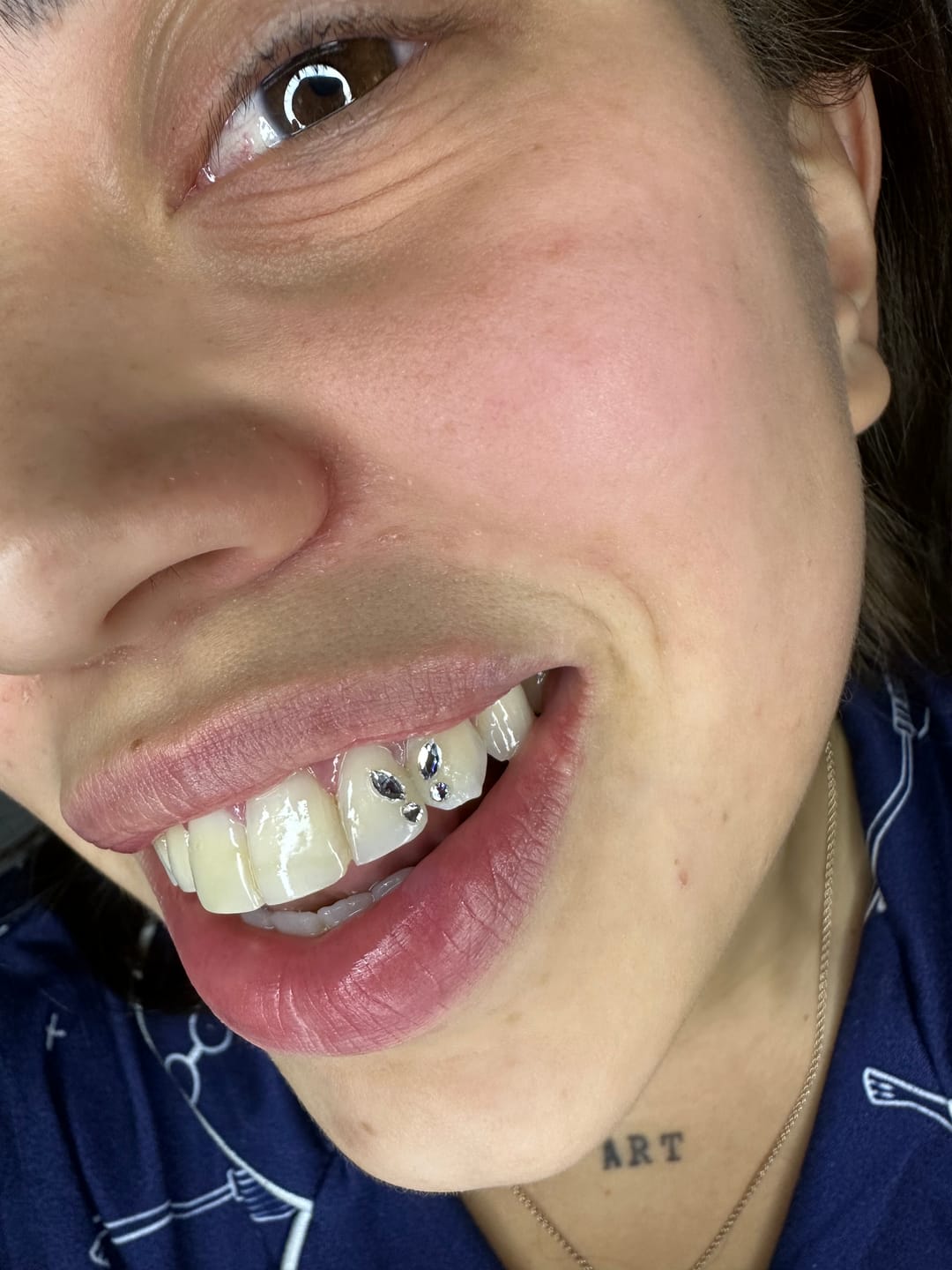 Customer photo review of Gemas Dentales Preciosa - Crystal