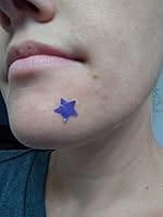 Customer photo review of 240ct Bright Blossoms Pimple Patches Hydrocolloid Patch Spot Treatment