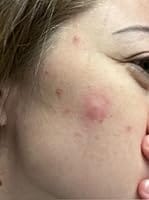 Customer photo review of 330CT Pimple Patches Hydrocolloid Patch Spot Treatment with Salicylic Acid, Tea Tree Oil & Calendula Oil - 4 Sizes