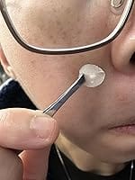 Customer photo review of 330CT Pimple Patches Hydrocolloid Patch Spot Treatment with Salicylic Acid, Tea Tree Oil & Calendula Oil - 4 Sizes