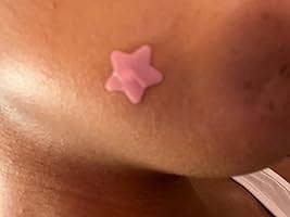 Customer photo review of 240ct Bright Blossoms Pimple Patches Hydrocolloid Patch Spot Treatment