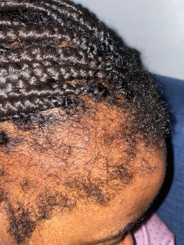 Customer photo review of Minoxidil+finasteride Solution - MEN ONLY, 3x60ml pack