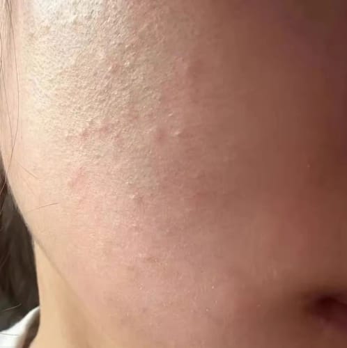 Customer photo review of OGANACELL DERX Cleanser 120mL - sensitive skin