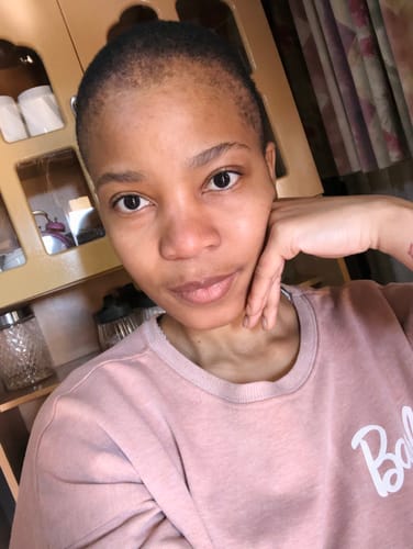 Customer photo review of Minoxidil REGULAR (2%) strength FOAM, 3x60ml Pack