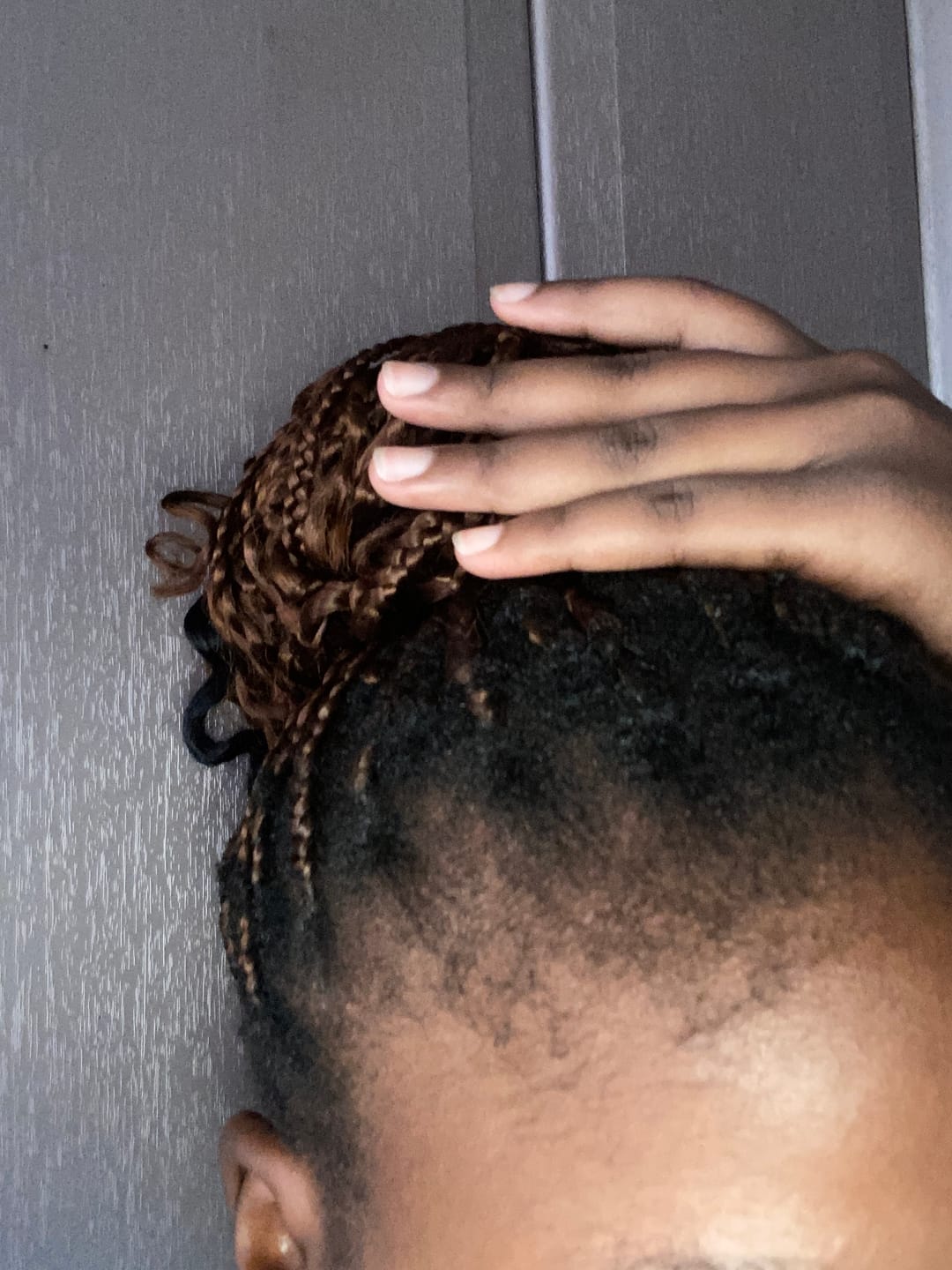 Customer photo review of Hairline Fortifying Serum 30ml - Minoxidil