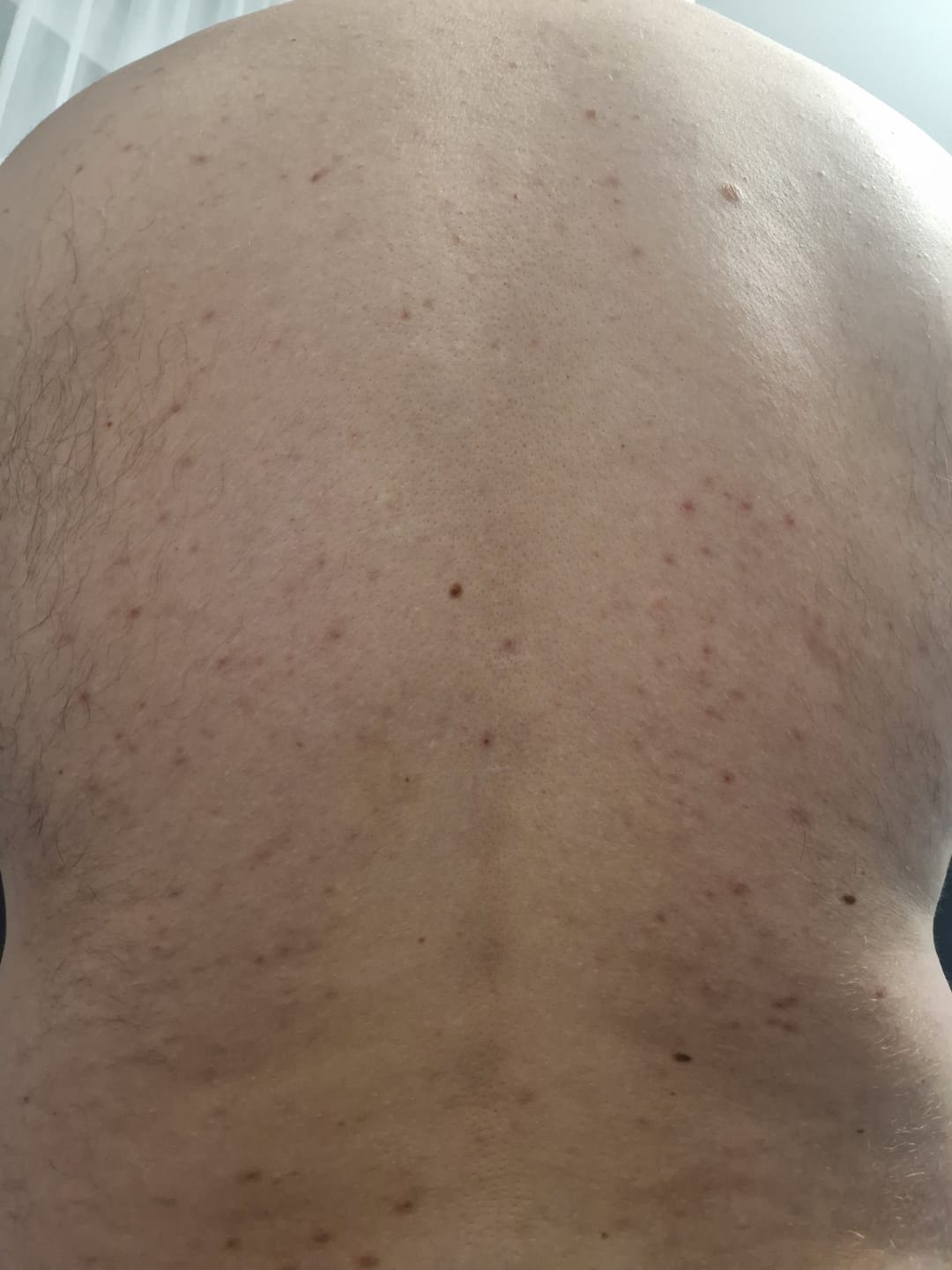Customer photo review of Rūgštinis odos purškalas nuo spuogų