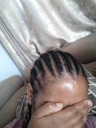 Customer photo review of Minoxidil 5% Solution, 1 Pack 60ml