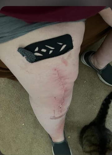 Customer photo review of Easy Kinesiology Tape (30-Day Supply)