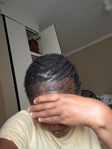 Customer photo review of Minoxidil 5% FOAM, 3x60ml pack