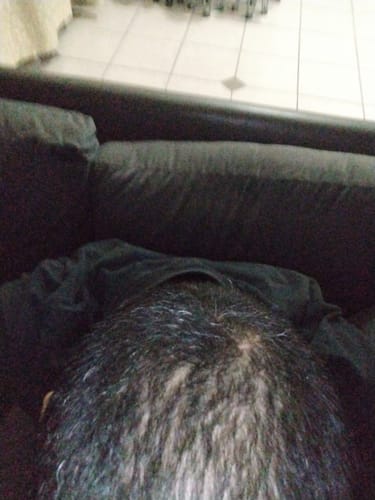 Customer photo review of Minoxidil DOUBLE ACTION FOAM, MEN ONLY 3x60ml Pack