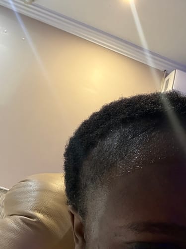 Customer photo review of Minoxidil 5% Solution, 1 Pack 60ml