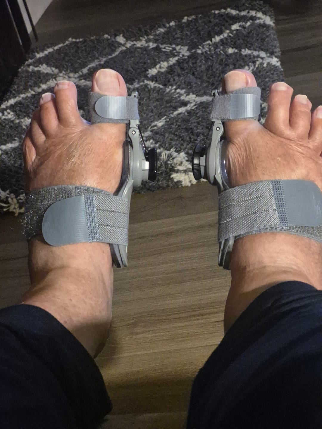 Customer photo review of Treatmedy™ Bunion Fix