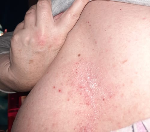 Customer's back showing red, irritated skin from psoriasis before using the F-Balm.