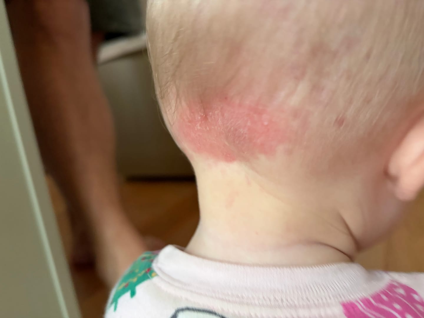 Customer photo review of Ultra-Fast Relief Balm for Dry, Itchy Skin – For Body & Face