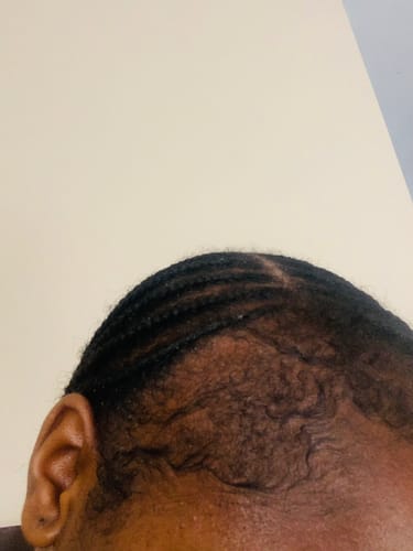 Customer photo review of Minoxidil 5% SOLUTION, 3x60ml pack