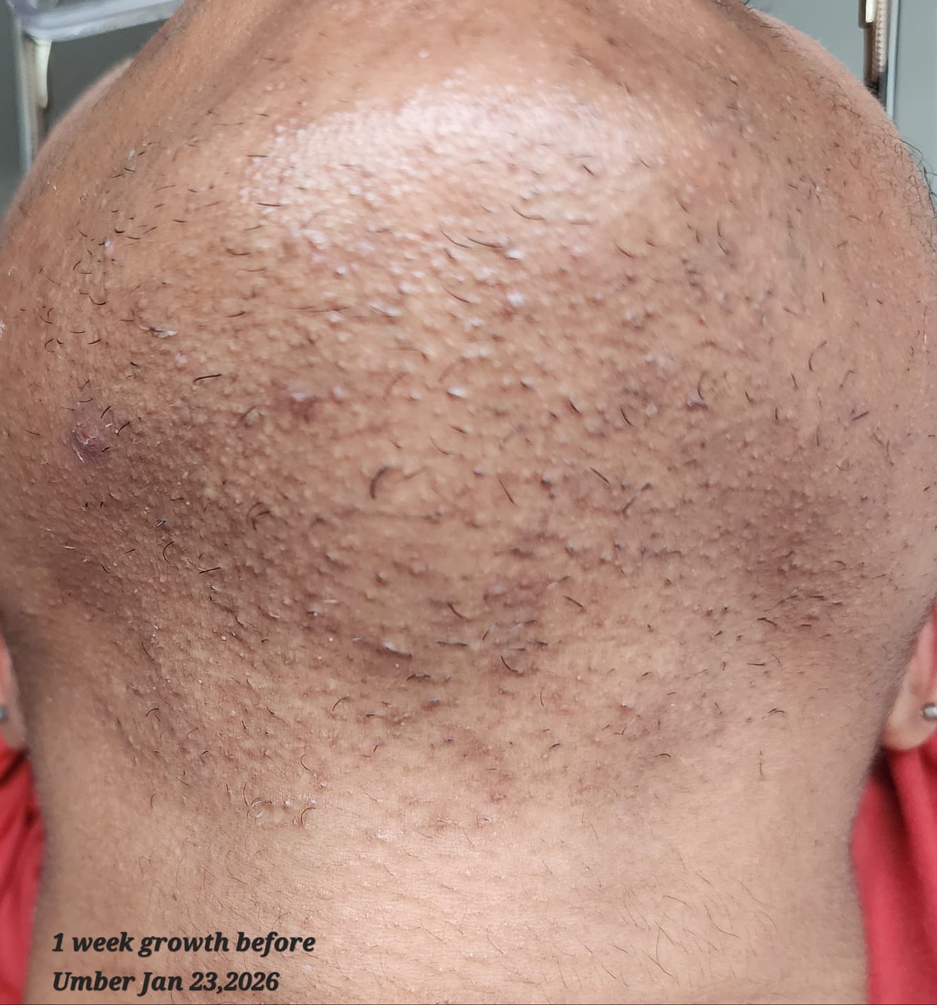 Customer photo review of Hair Reducing Fade Oil - Slows Growth, Thins, and Reduces Hair Naturally
