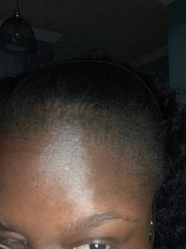 Customer photo review of Minoxidil 5% SOLUTION, 3x60ml pack