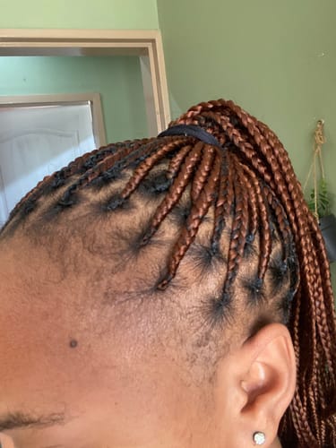 Customer photo review of Minoxidil5% Solution, 1 Pack 60ml