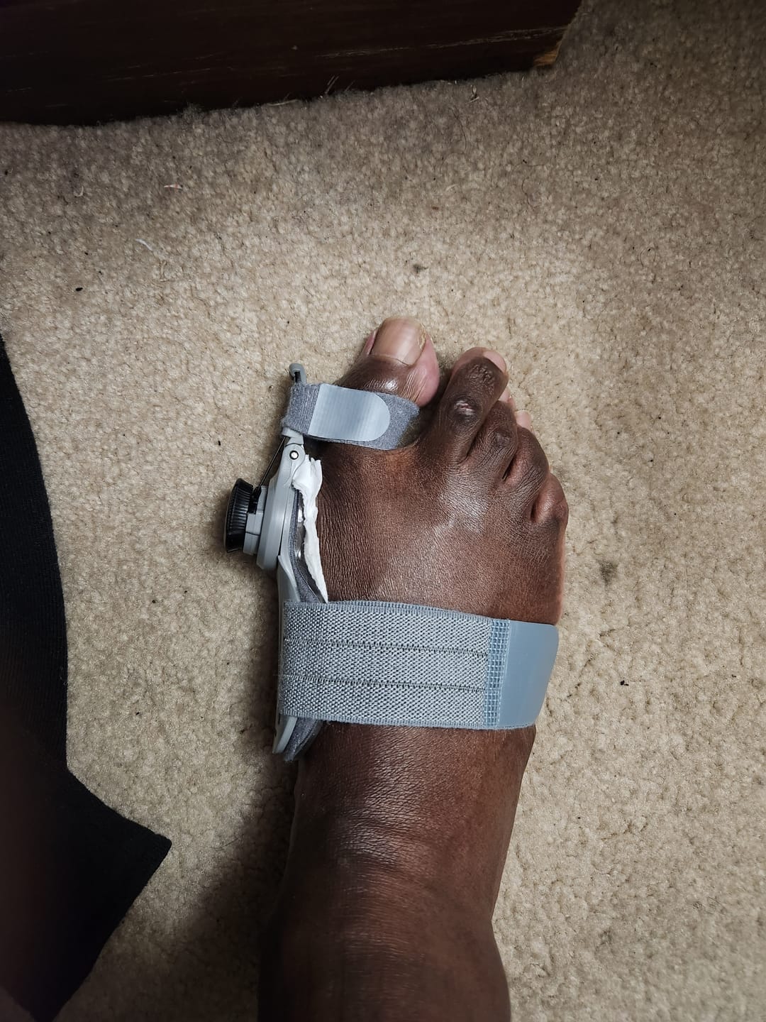 Customer photo review of Treatmedy™ Bunion Fix