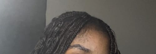 Customer photo review of Minoxidil5% Solution, 1 Pack 60ml