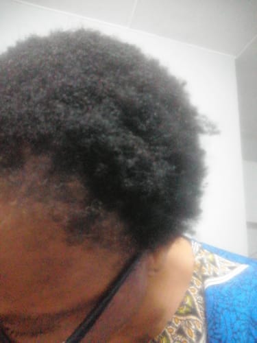 Customer photo review of Minoxidil High Strength (5%) FOAM, 3x60ml pack