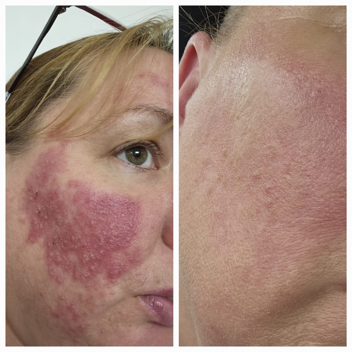 Customer photo review of Rosalique 3 in 1 Anti-Redness Miracle Formula SPF50