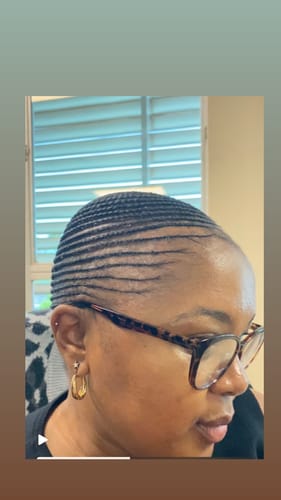 Customer photo review of Minoxidil 5% FOAM, 3 x 60ml pack