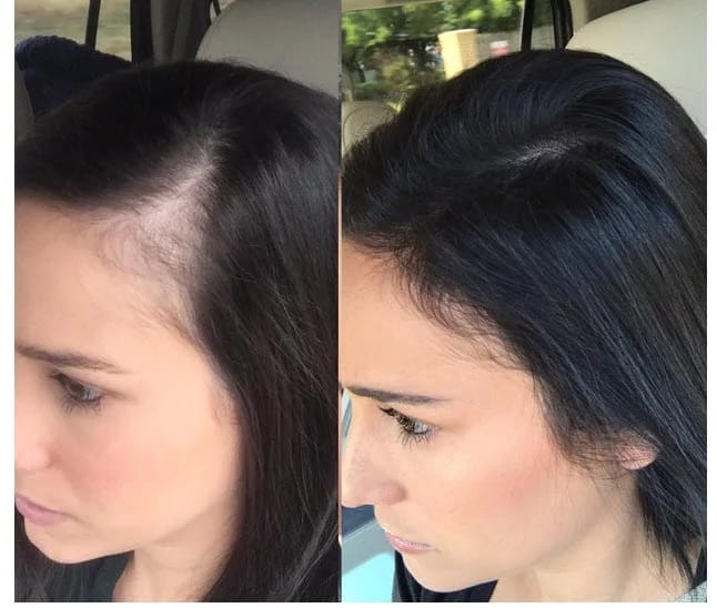 Customer photo review of Dual-Applicator Hair Regrowth System