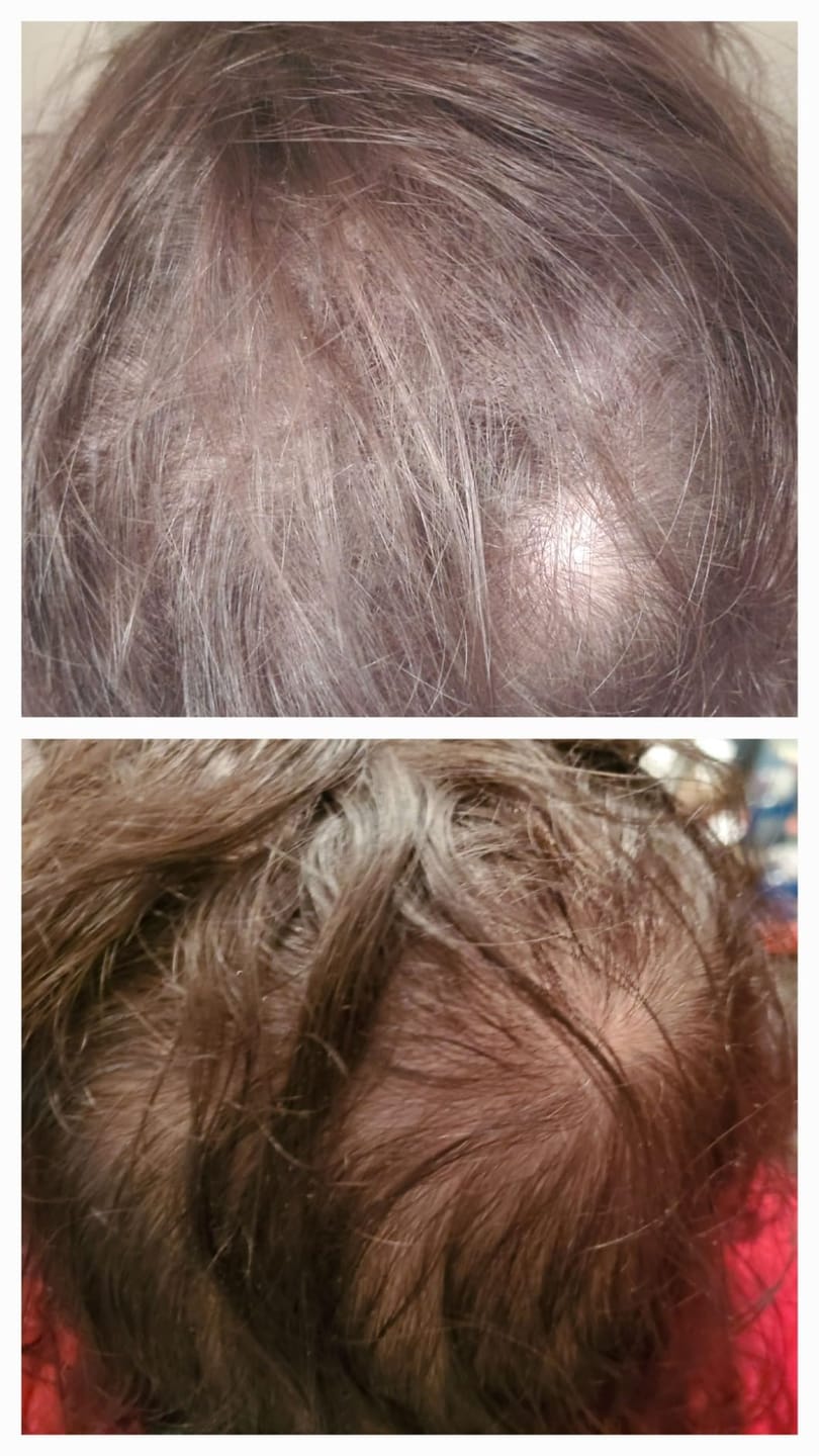 Customer photo review of Dual-Applicator Hair Regrowth System