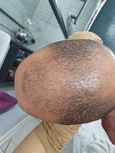 Customer photo review of Minoxidil+DHT Blocker FOAM, MEN ONLY 3x60ml Pack