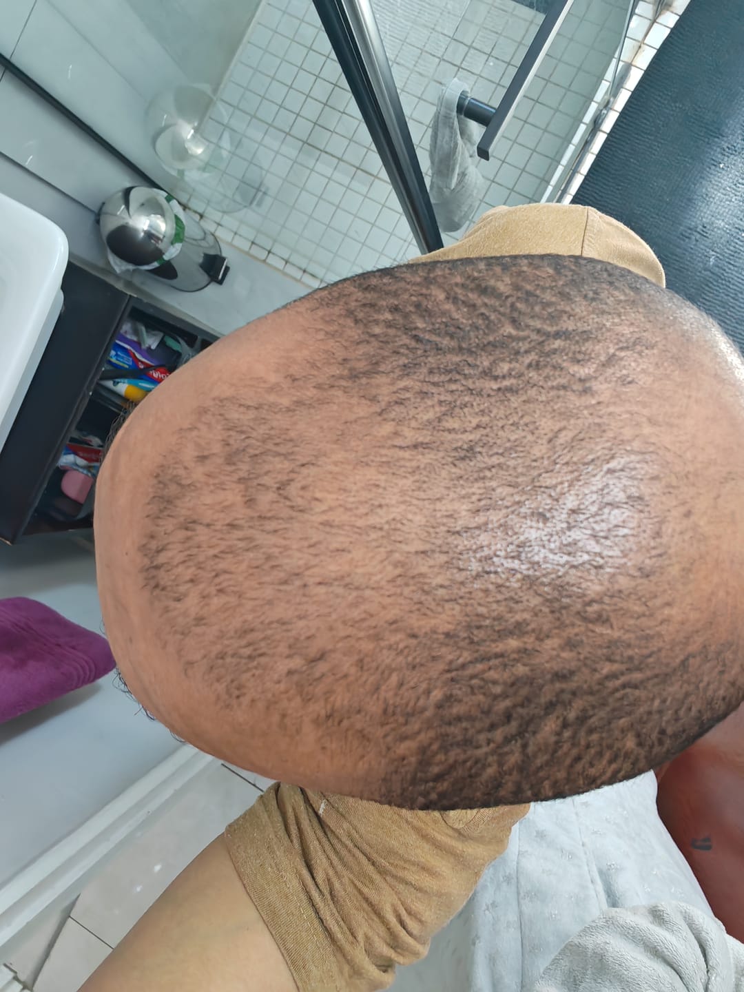 Customer photo review of Minoxidil+DHT Blocker FOAM, MEN ONLY 3x60ml Pack
