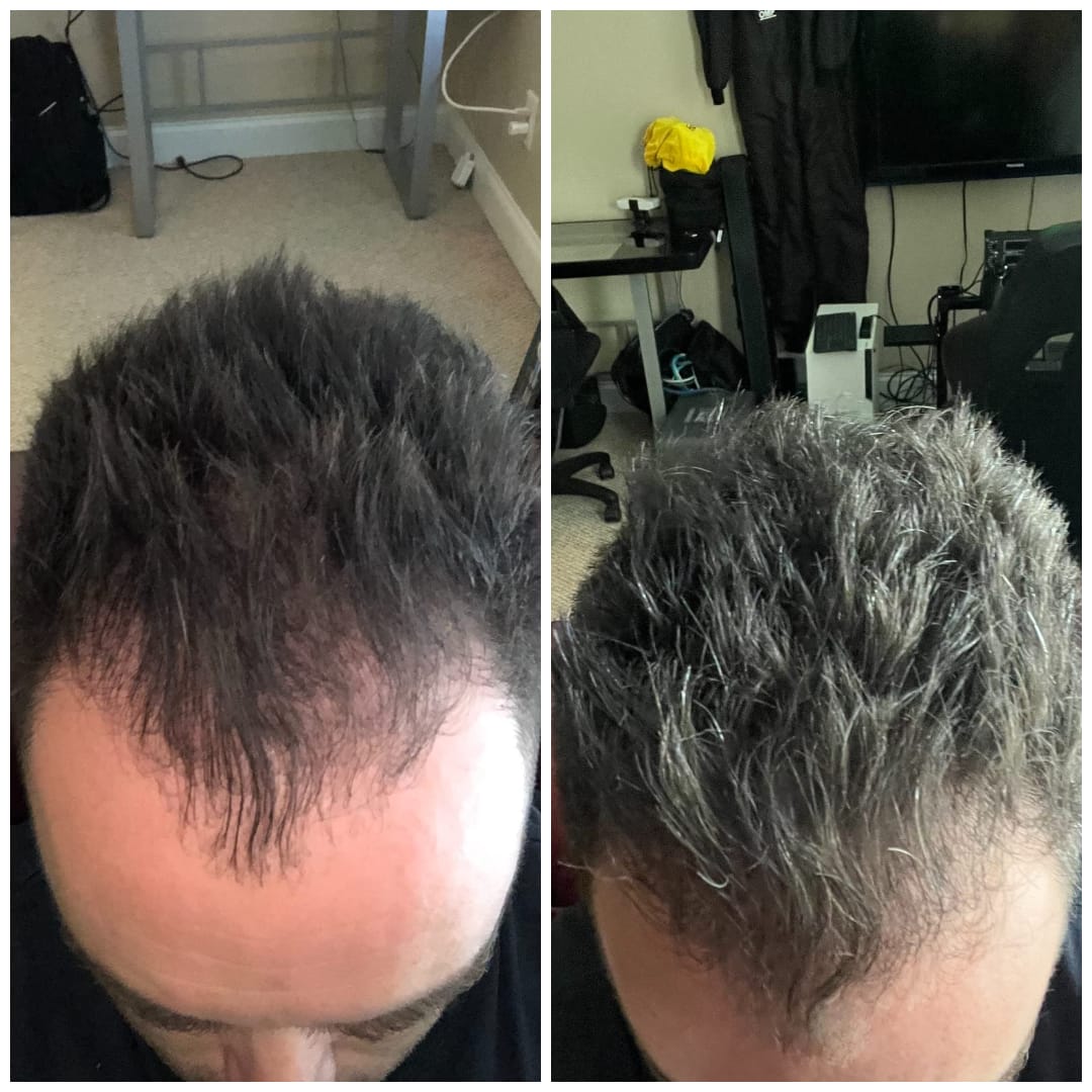 Customer photo review of Dual-Applicator Hair Regrowth System