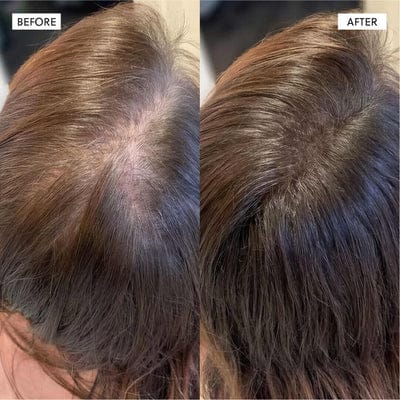 Customer photo review of Dual-Applicator Hair Regrowth System