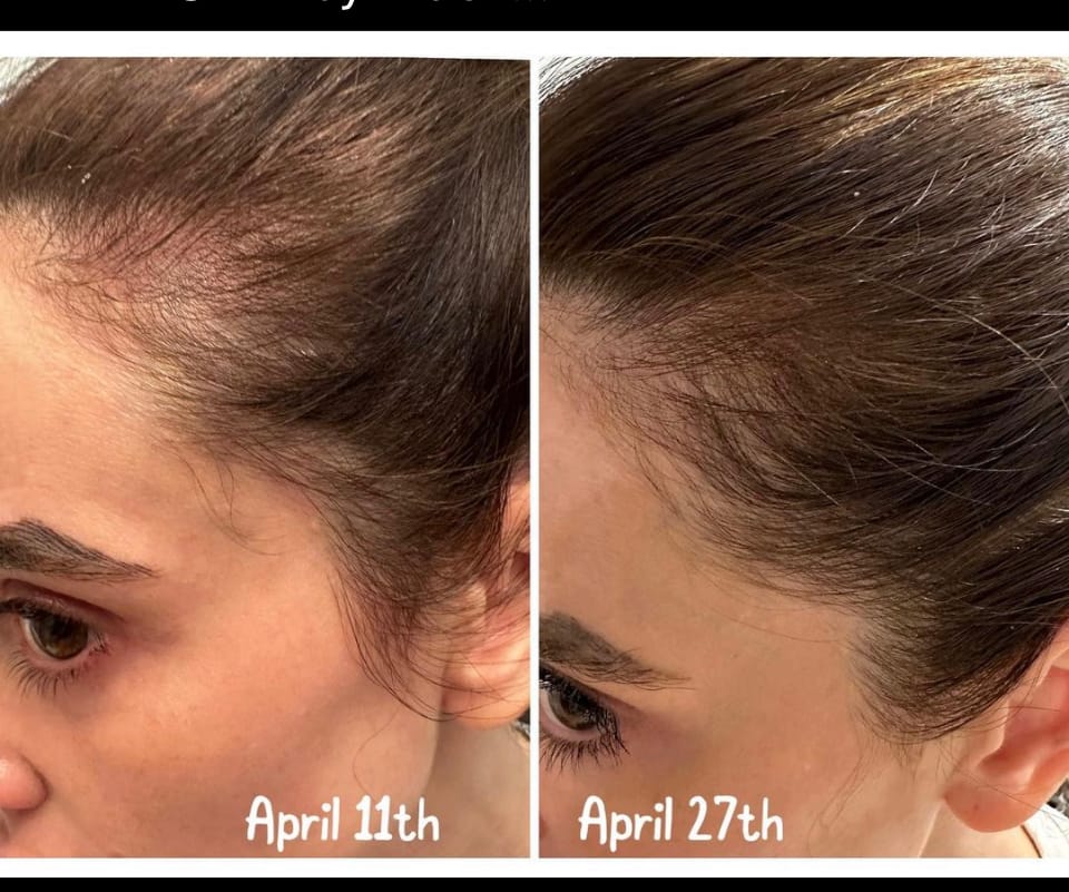 Customer photo review of Dual-Applicator Hair Regrowth System