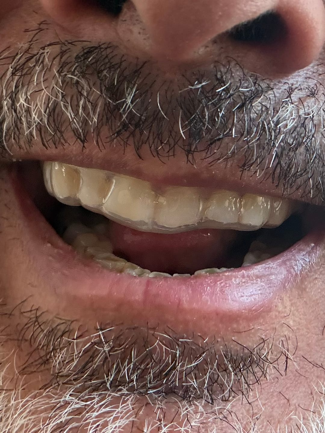 Customer photo review of Clear Custom Night Guard