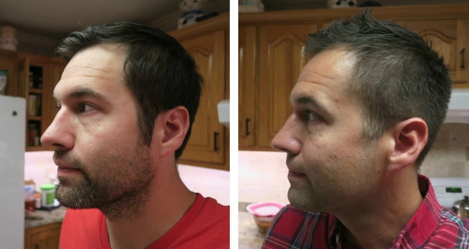 Customer photo review of Dual-Applicator Hair Regrowth System