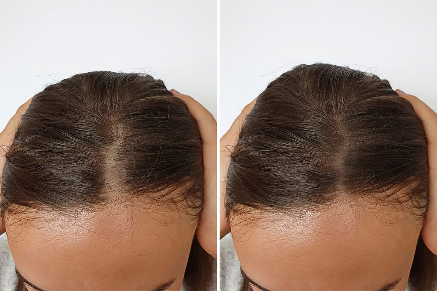Customer photo review of Dual-Applicator Hair Regrowth System