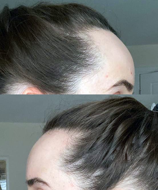 Customer photo review of Dual-Applicator Hair Regrowth System