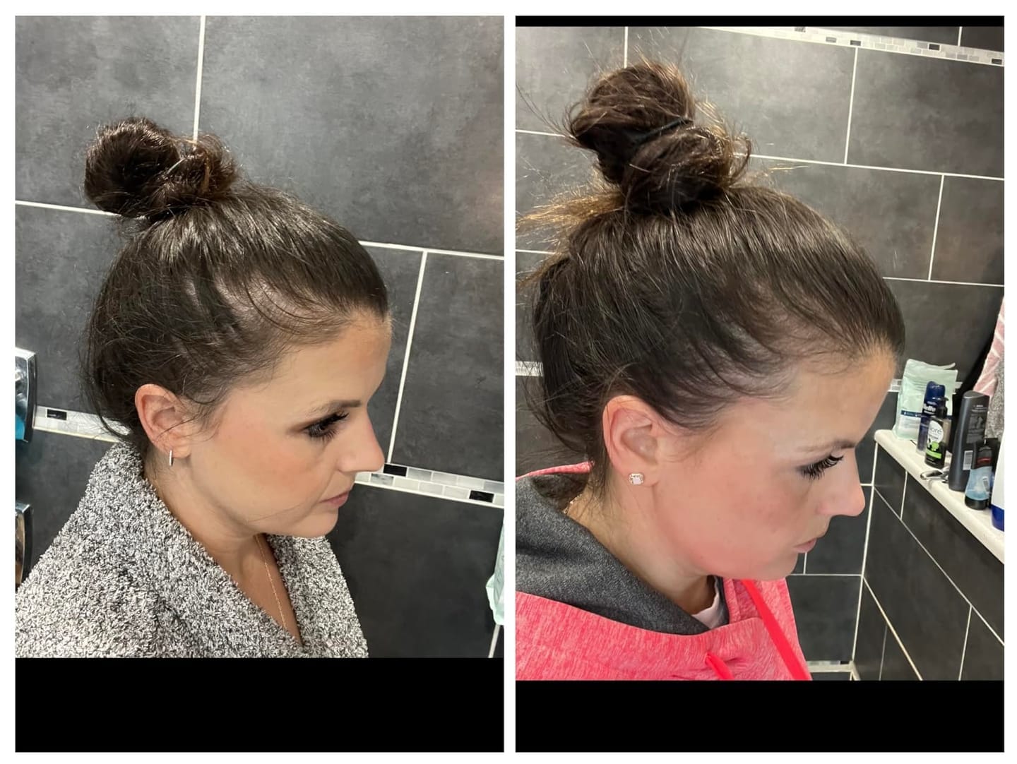 Customer photo review of Dual-Applicator Hair Regrowth System