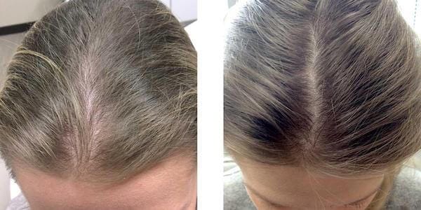 Customer photo review of Dual-Applicator Hair Regrowth System