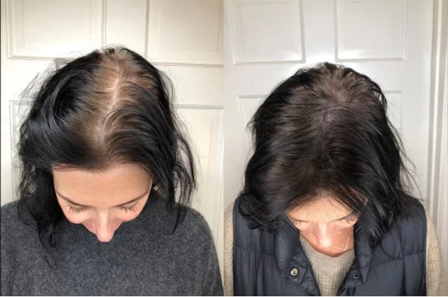 Customer photo review of Dual-Applicator Hair Regrowth System