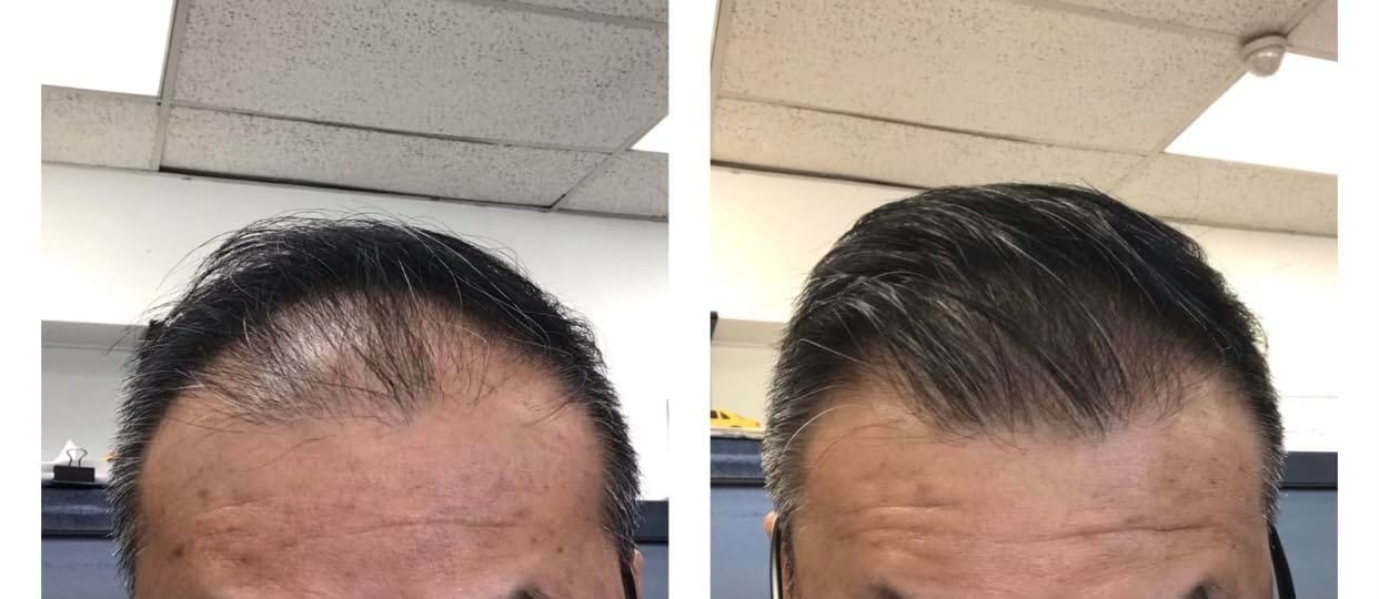 Customer photo review of Dual-Applicator Hair Regrowth System
