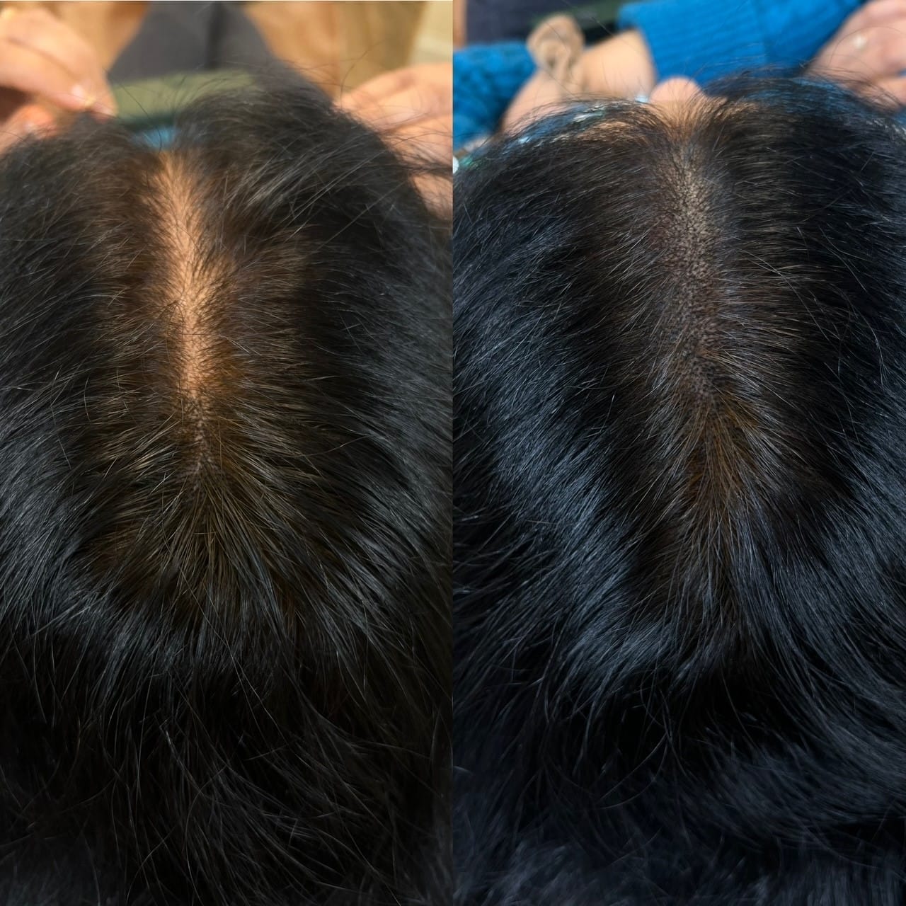 Customer photo review of Dual-Applicator Hair Regrowth System