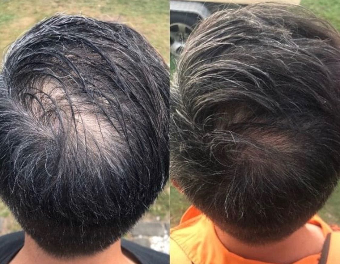 Customer photo review of Dual-Applicator Hair Regrowth System