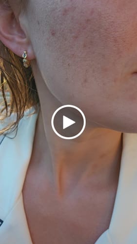 Customer video review of Skin & Gut Maintain™ + Pimple Pals™