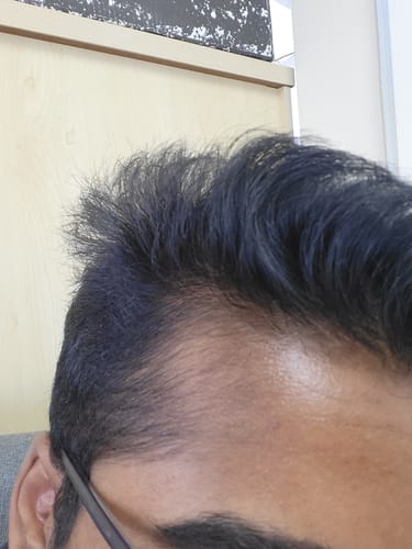 Customer photo review of Minoxidil DOUBLE ACTION FOAM, MEN ONLY 3x60ml Pack